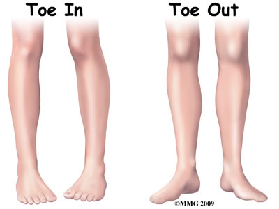 In-toeing and Out-toeing
