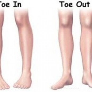 In-Toeing and Out-toeing
