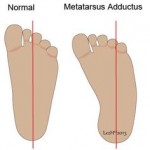 The Podiatry Group: Positional Talipes and Metatarsus Adductus