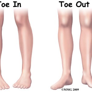 In-toeing and Out-toeing