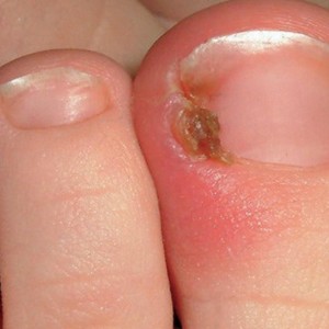 Ingrown toenails