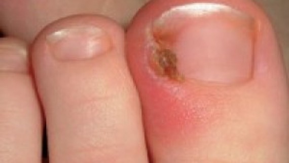 Tennis Toe  How it Should be Treated  By Dr Gurinder Bedi  Lybrate